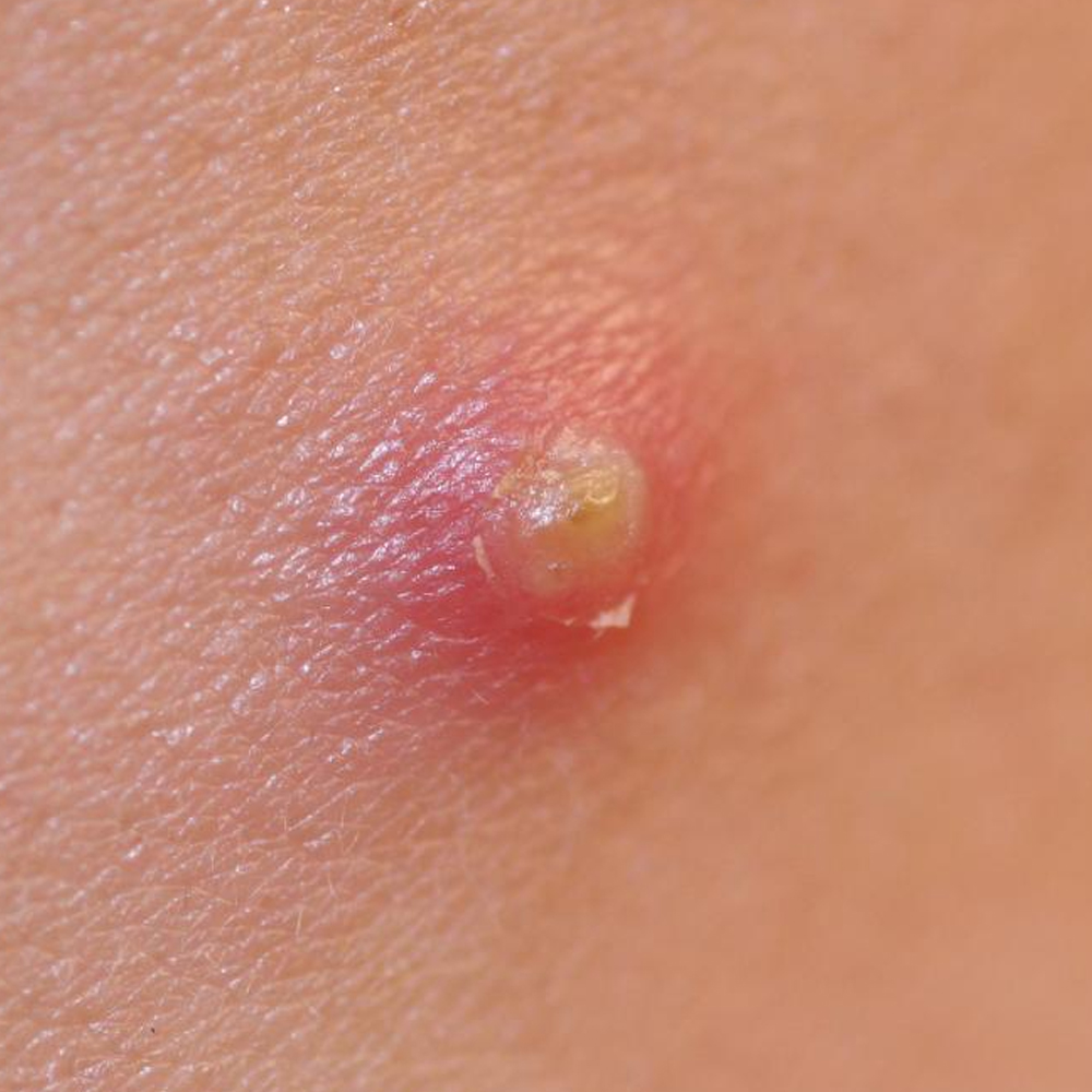 pustulas
